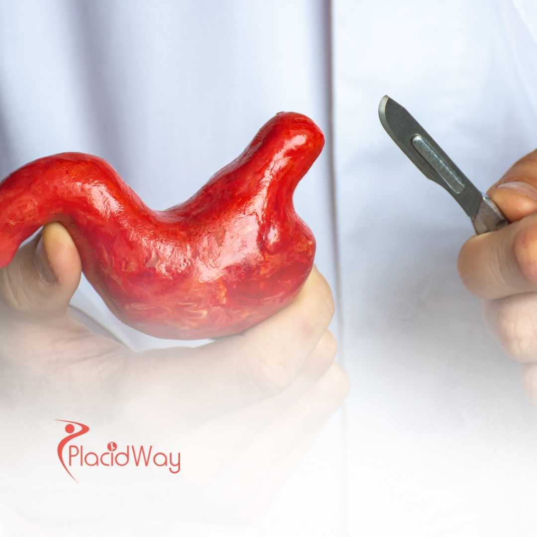 Gastric Sleeve Surgery in Istanbul: Weight Loss Solutions for Birmingham Patients