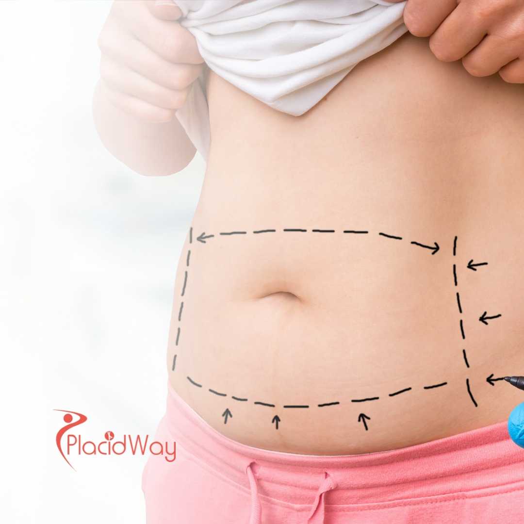 Liposuction in Colombia: Why Bahamian Patients Choose Colombia for Body Contouring