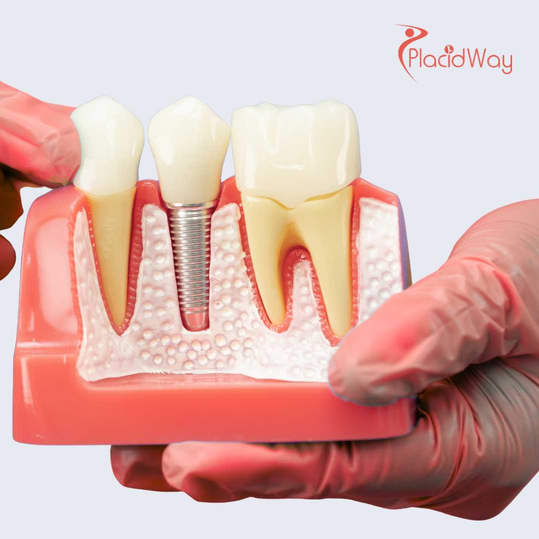 Dental Implants in Mexico (Los Algodones) for San Diego Patients Saving on Dental Costs