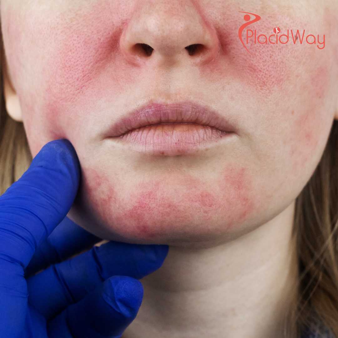 V-Beam Laser Treatments in Korea for Rosacea Control and Facial Redness Reduction