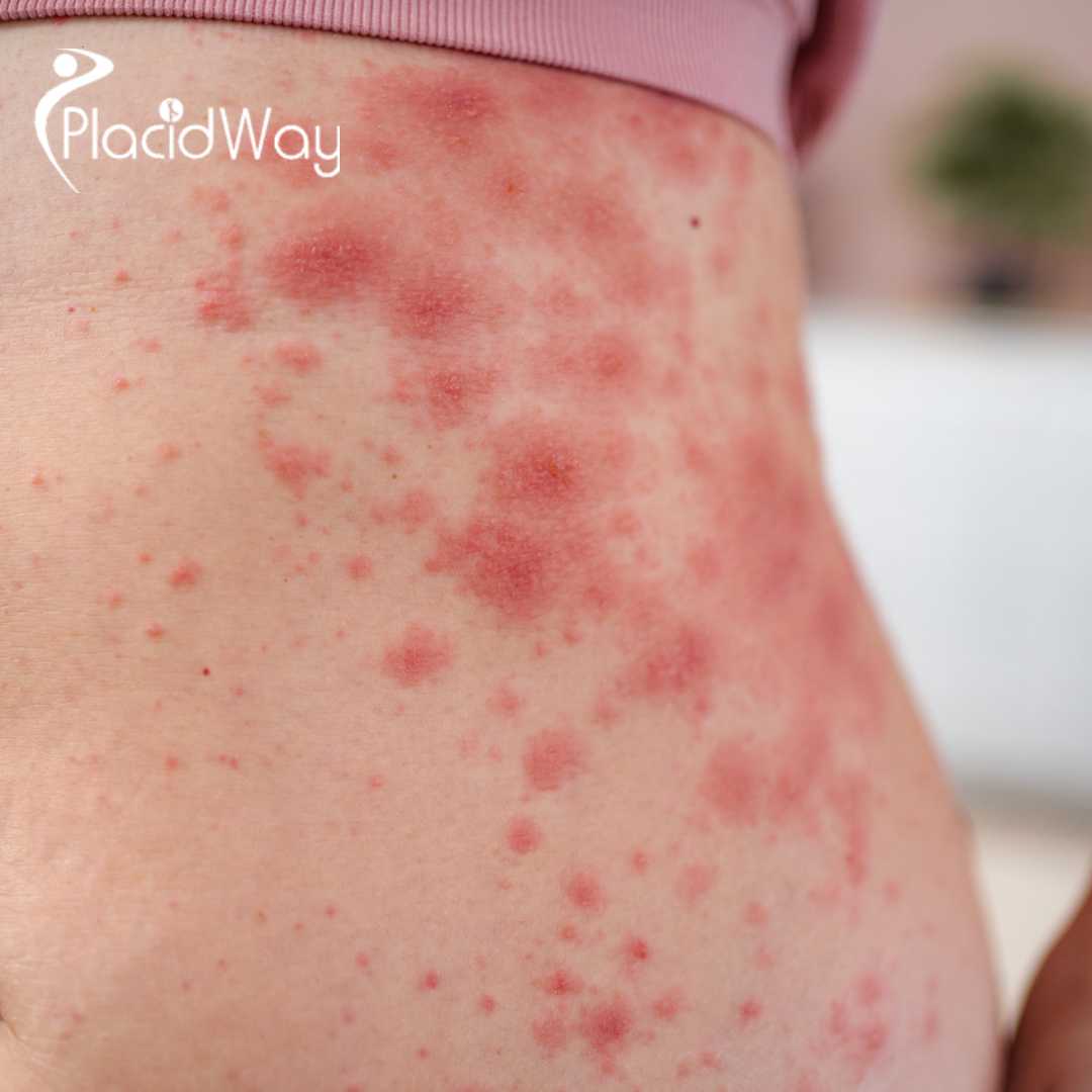 Lupus No More: How Canadians Are Reversing Symptoms with Stem Cells in Guadalajara