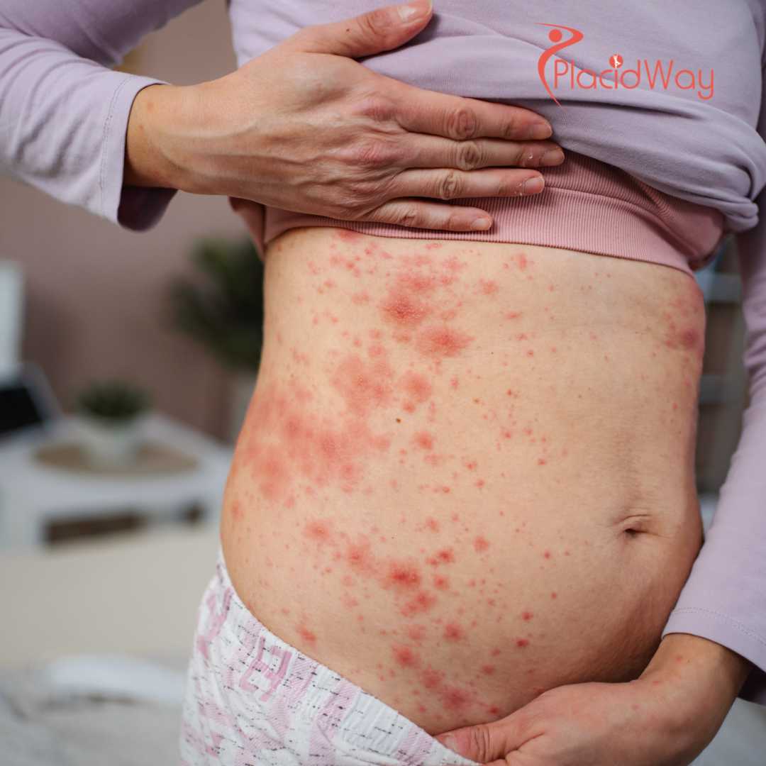 Clear Skin Awaits: U.S. Psoriasis Patients Are Finding Real Relief in Mexico’s Stem Cell Clinics!