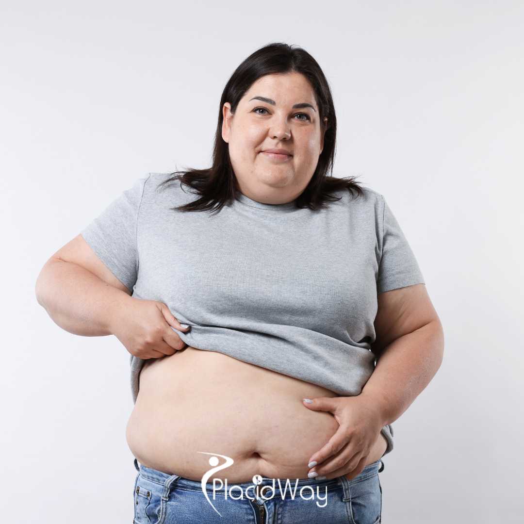 Gastric Sleeve in Turkey vs UK - Bypassing 36-Month NHS Wait Times for British Patients, Brands, and Quality Standards Compared