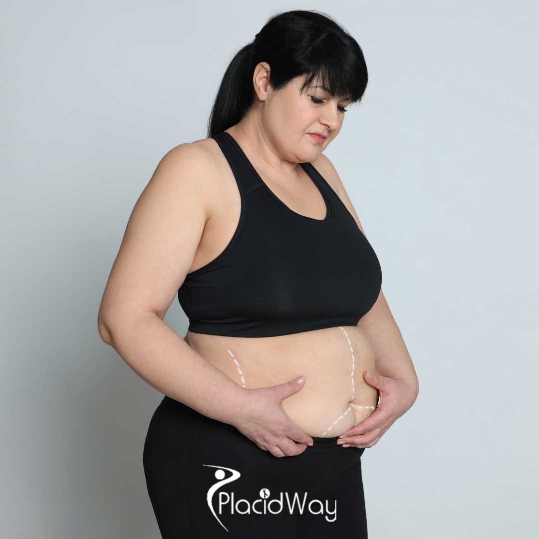 Gastric Sleeve in Turkey vs Spain - Comparing €4,000 All-Inclusive Packages for Irish Seekers, Brands, and Quality Standards Compared