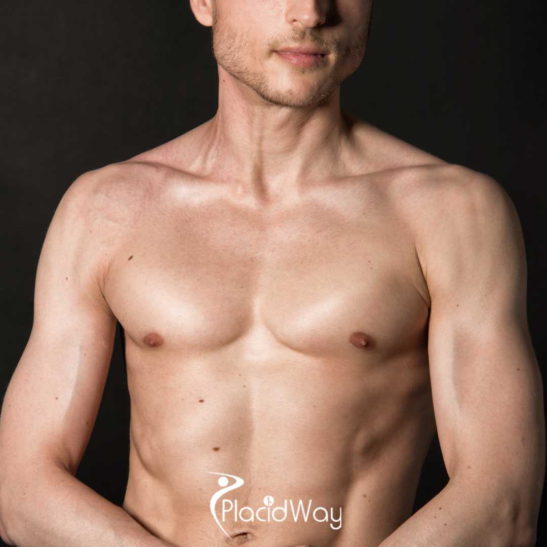 5 Key Differences in Male Breast Reduction (Gynecomastia) Surgery in Mexico vs US