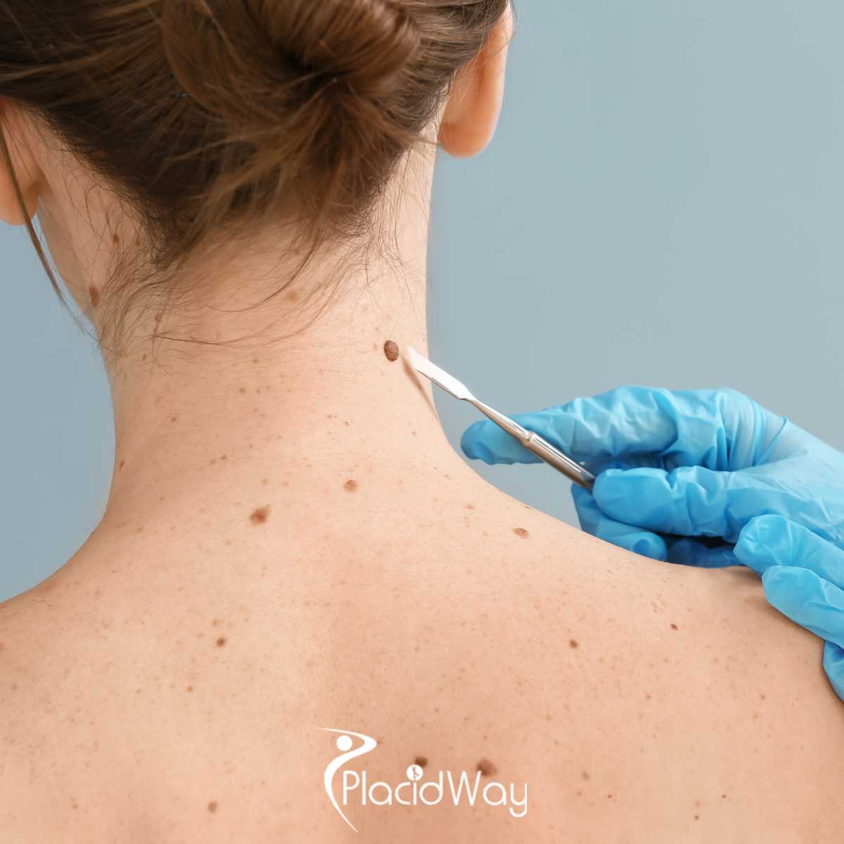 Melanoma That Has Spread Beyond the Skin: Advanced Treatment Options in Mexico