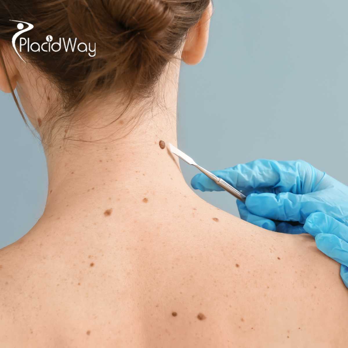 Advanced Melanoma Treatment in Tijuana - Targeting Metastasis When Standard Care Fails