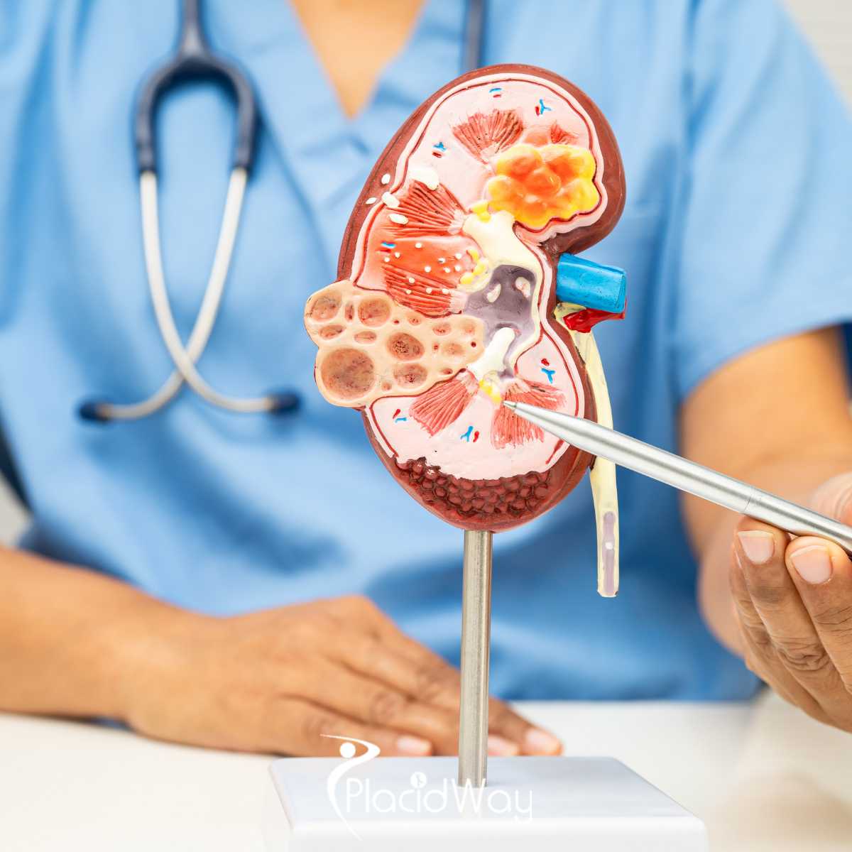 Integrative Kidney Cancer Treatment in Tijuana - Preserving Renal Function