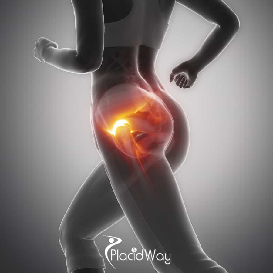 Hip Replacement Surgery in Mexico: Affordable, Reliable Surgery for California Tourists