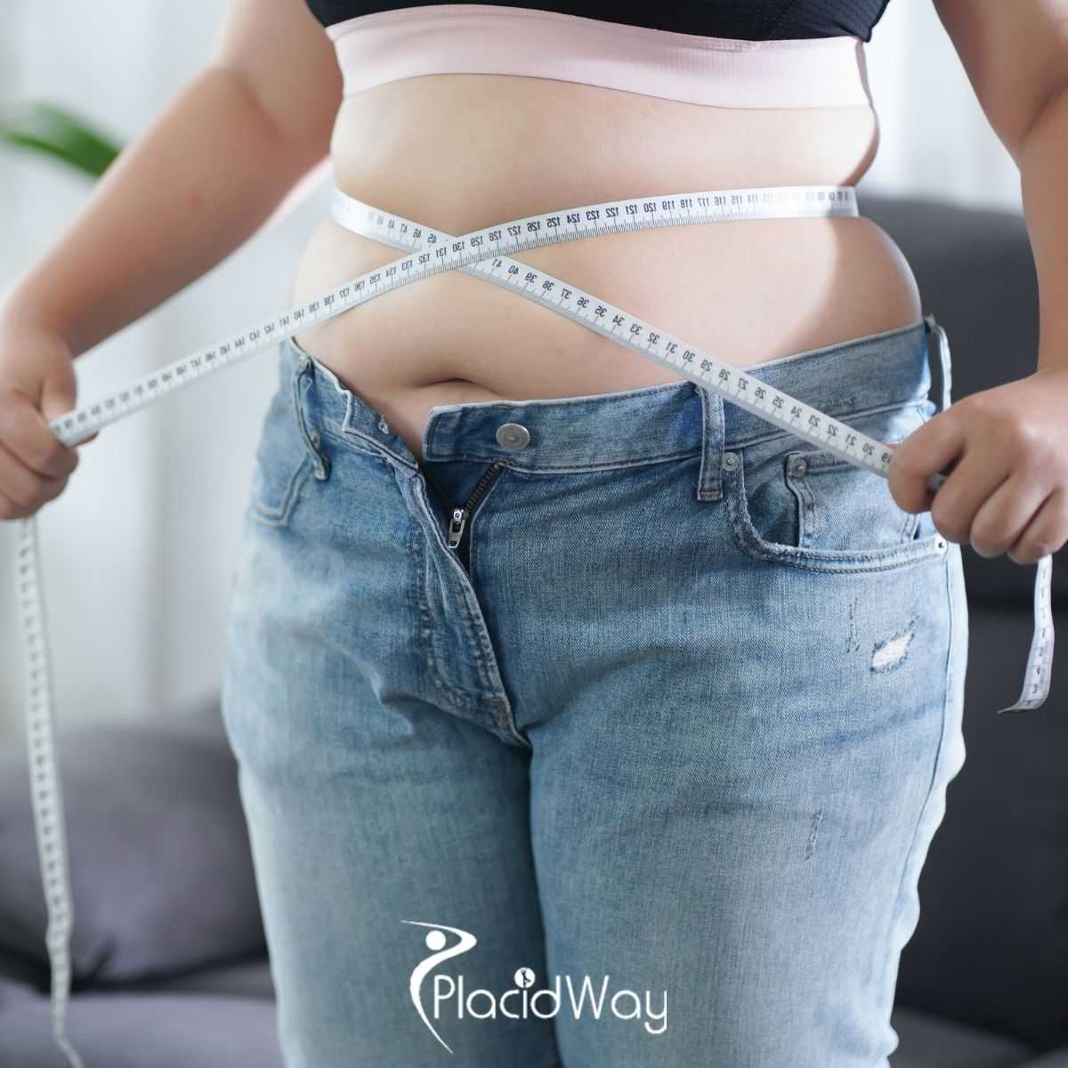 Revisional Bariatric Surgery in Turkey: Advanced Options for UK Patients