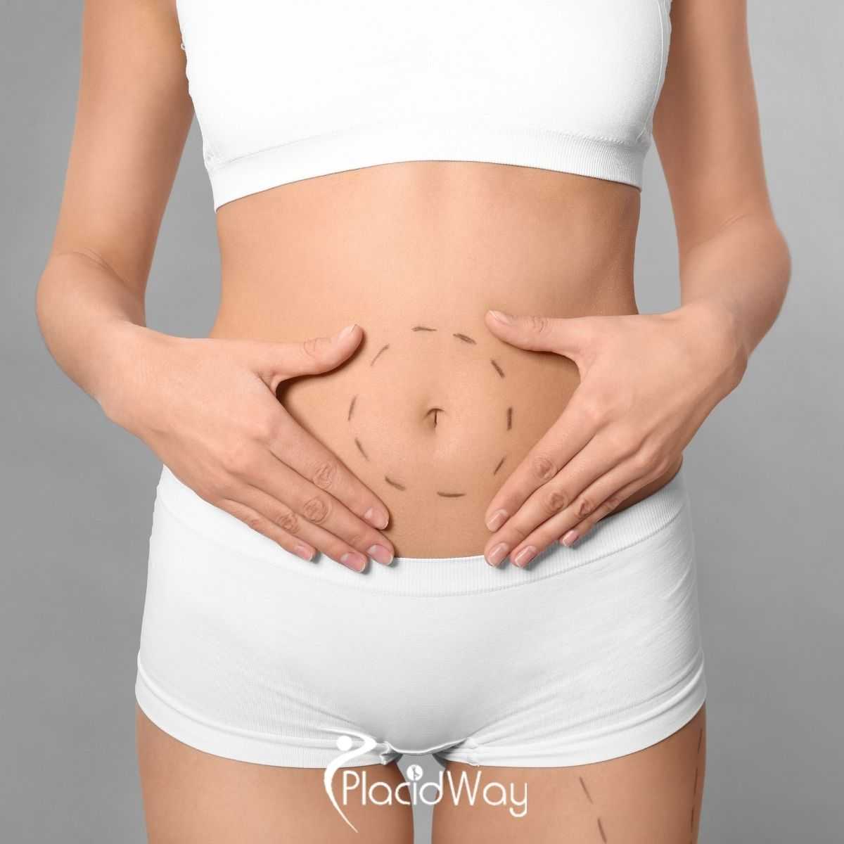 Tummy Tuck in Istanbul Turkey: What Patients Should Know Before Choosing Body Contouring Surgery