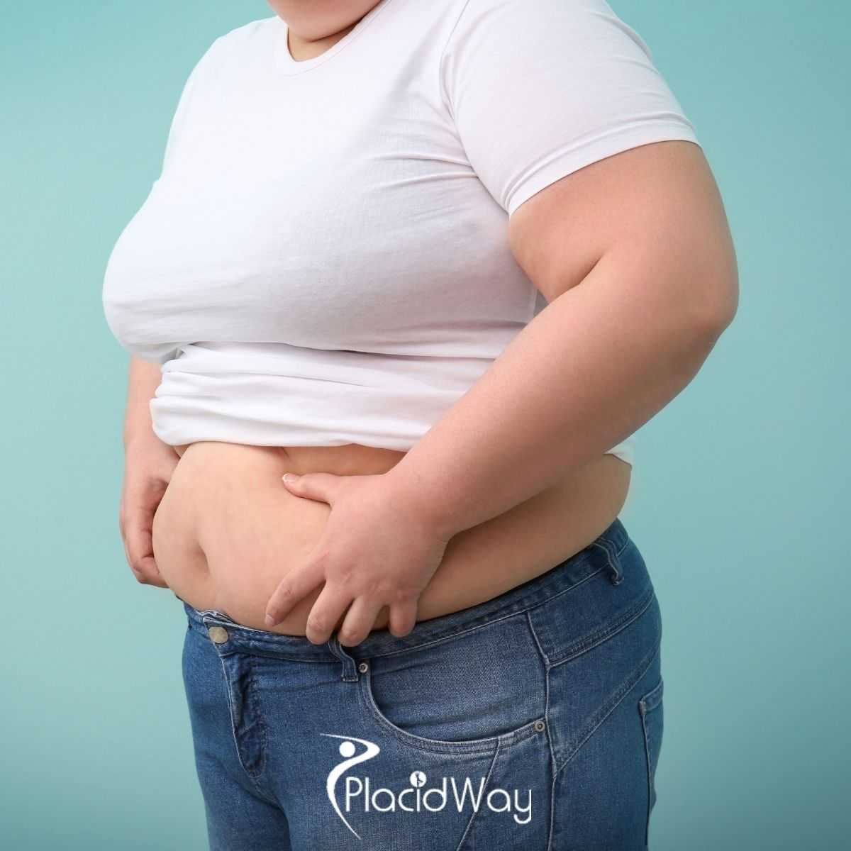 Planning Bariatric Surgery in Mexico: What Patients Should Prepare For