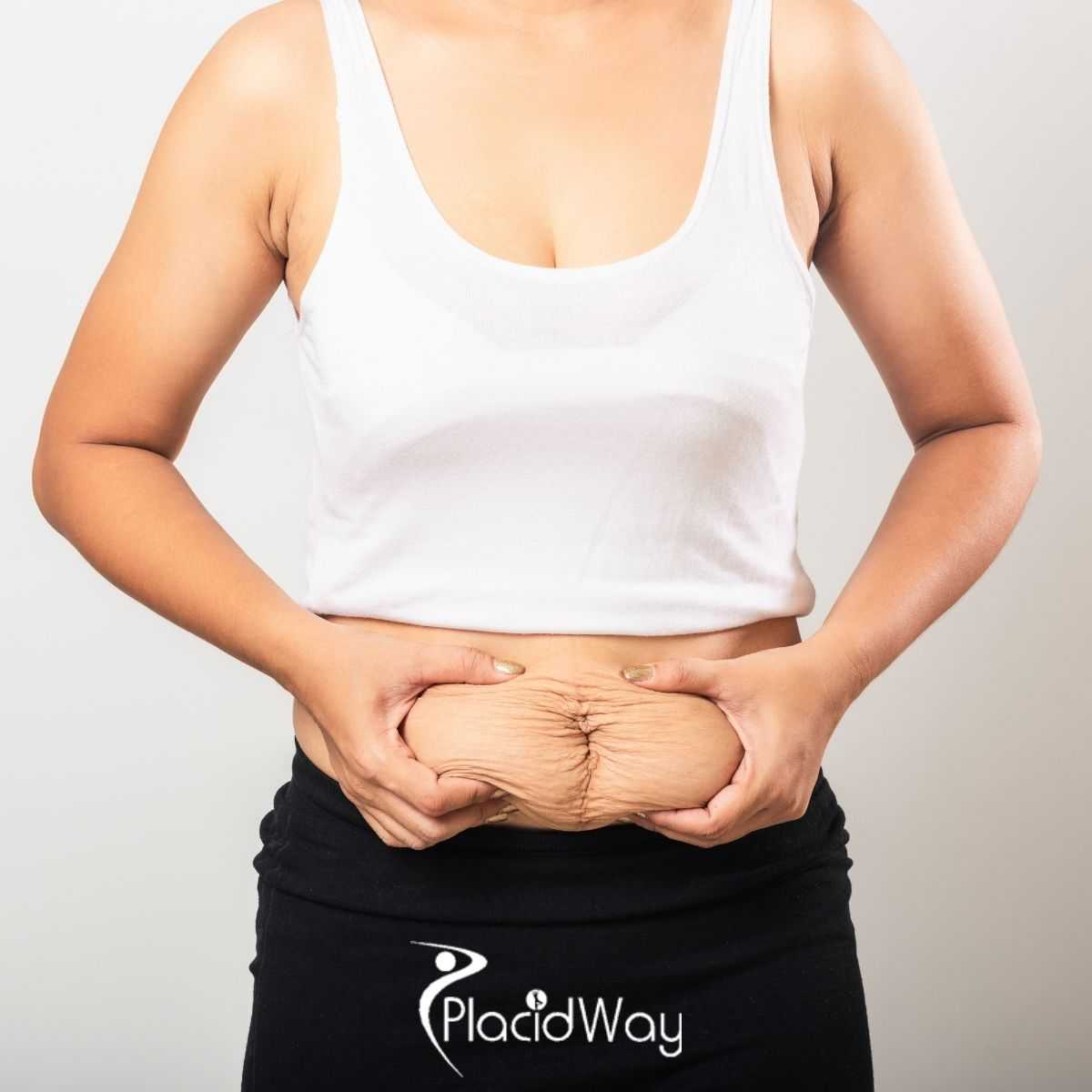 What to Know Before Choosing Bariatric Surgery in Mexico