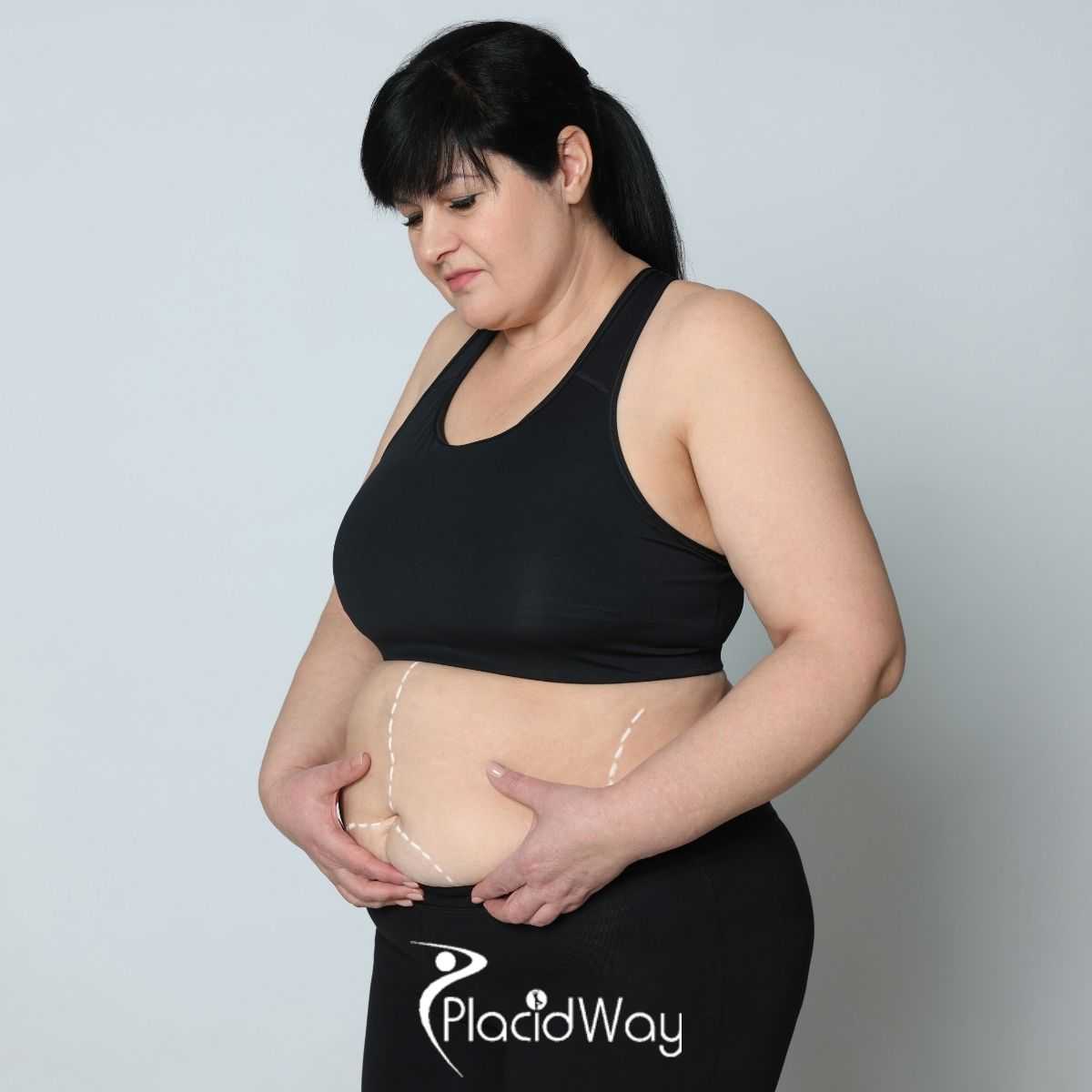 What to Know Before Choosing Tummy Tuck in Mexico