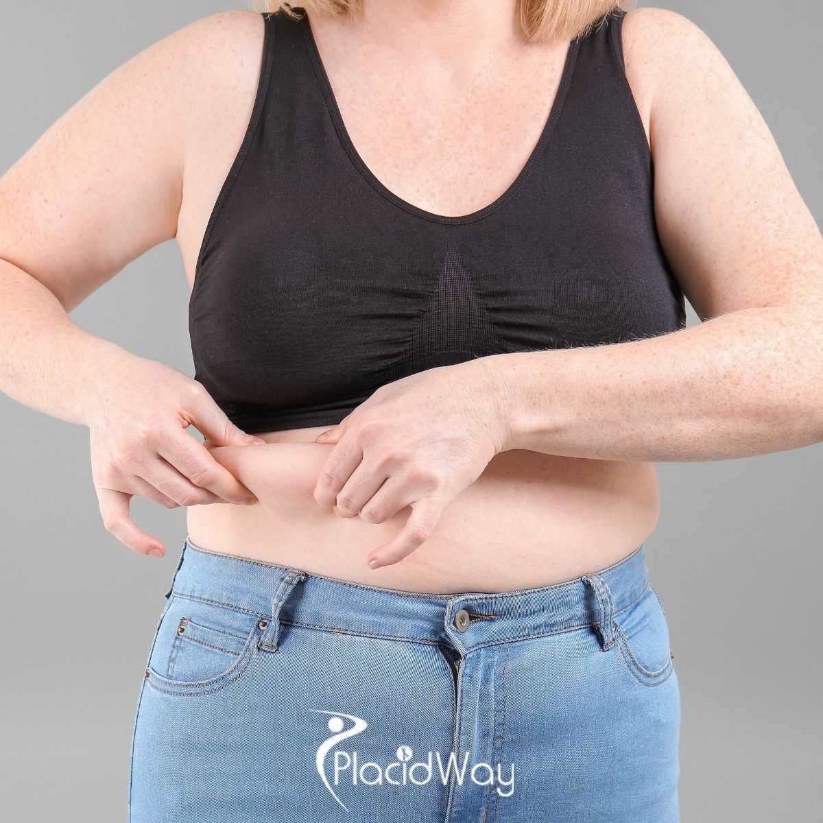 Planning Bariatric Surgery in New Delhi, India: What Patients Should Prepare For
