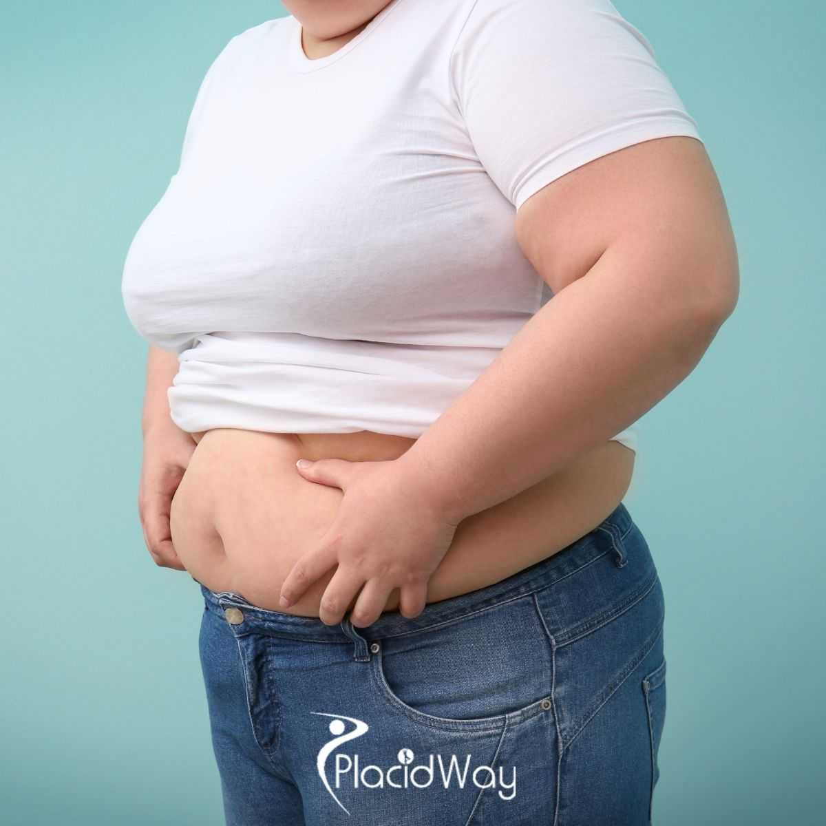 Bariatric Surgery in Turkey for Ontario Residents