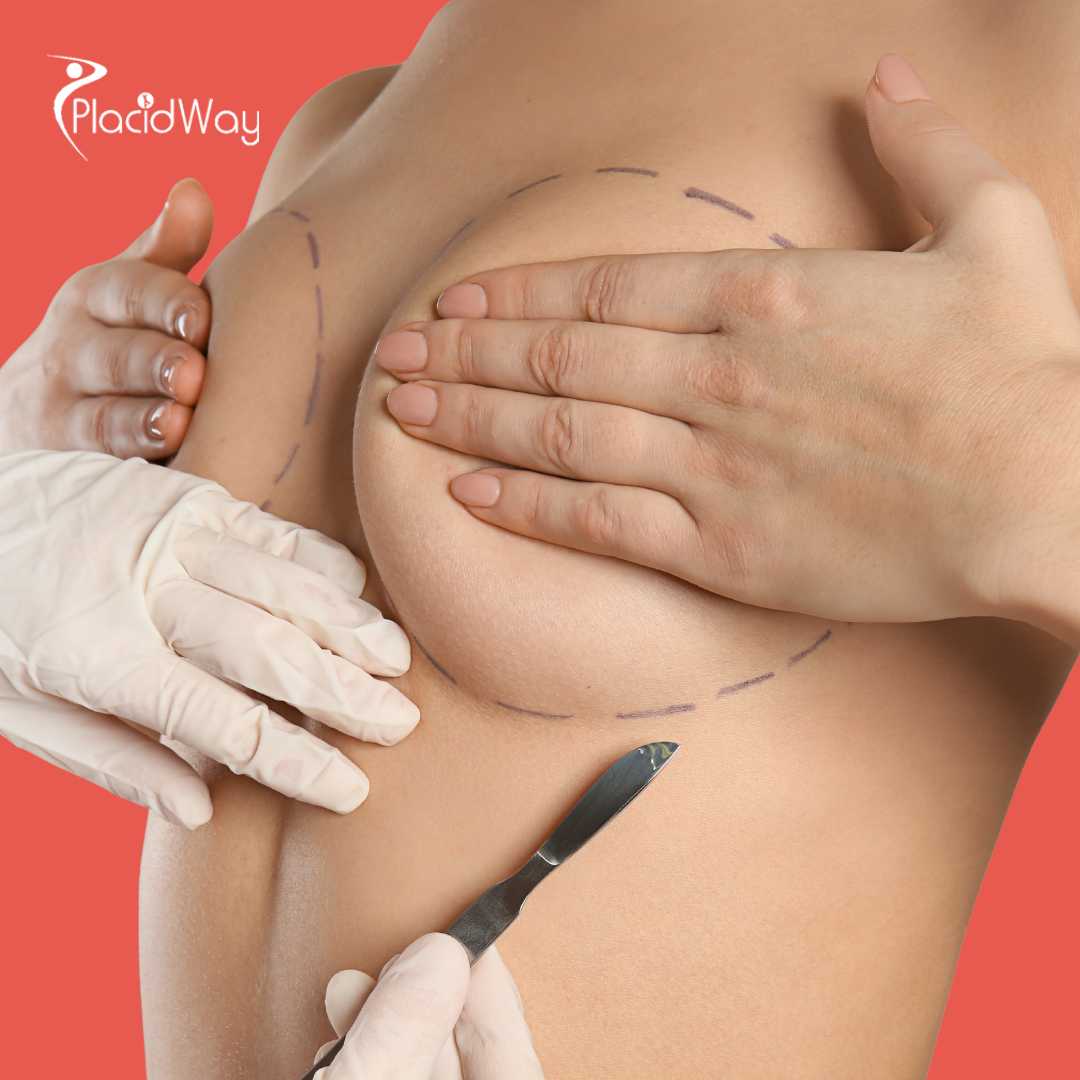 Breast Augmentation in Colombia