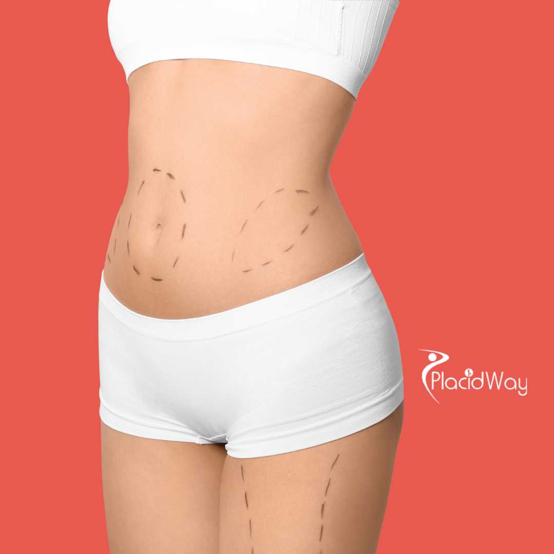 Tummy Tuck in Thailand