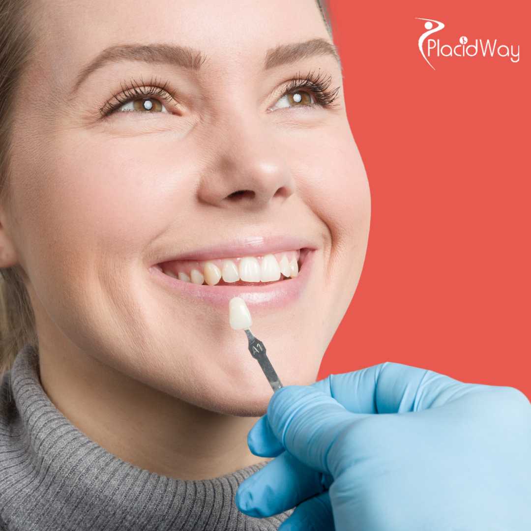 Dental Veneers in Cancun, Mexico