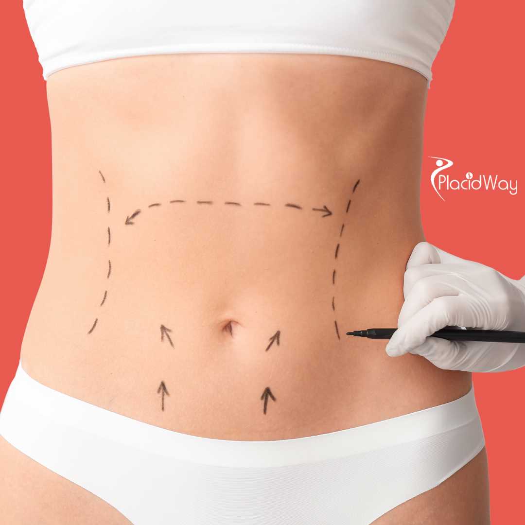 Mommy Makeover in Antalya, Turkey