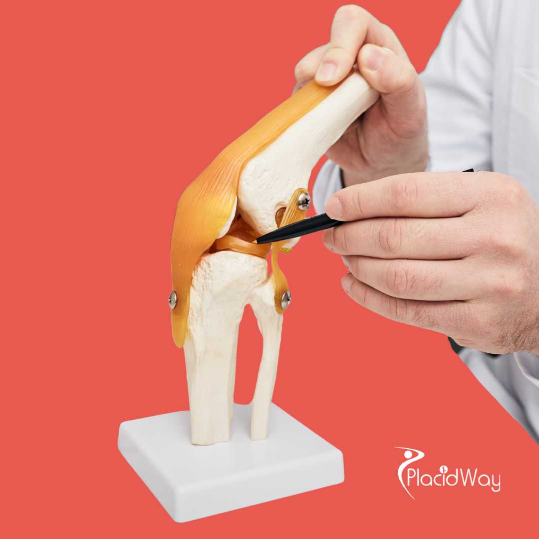 Meniscus Tear Repair in Puerto Vallarta, Mexico