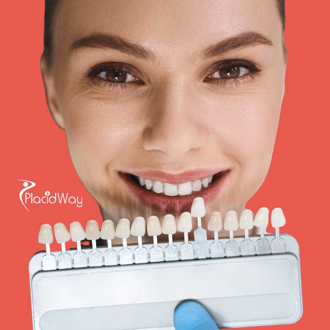 Dental Veneers in San Jose Costa Rica