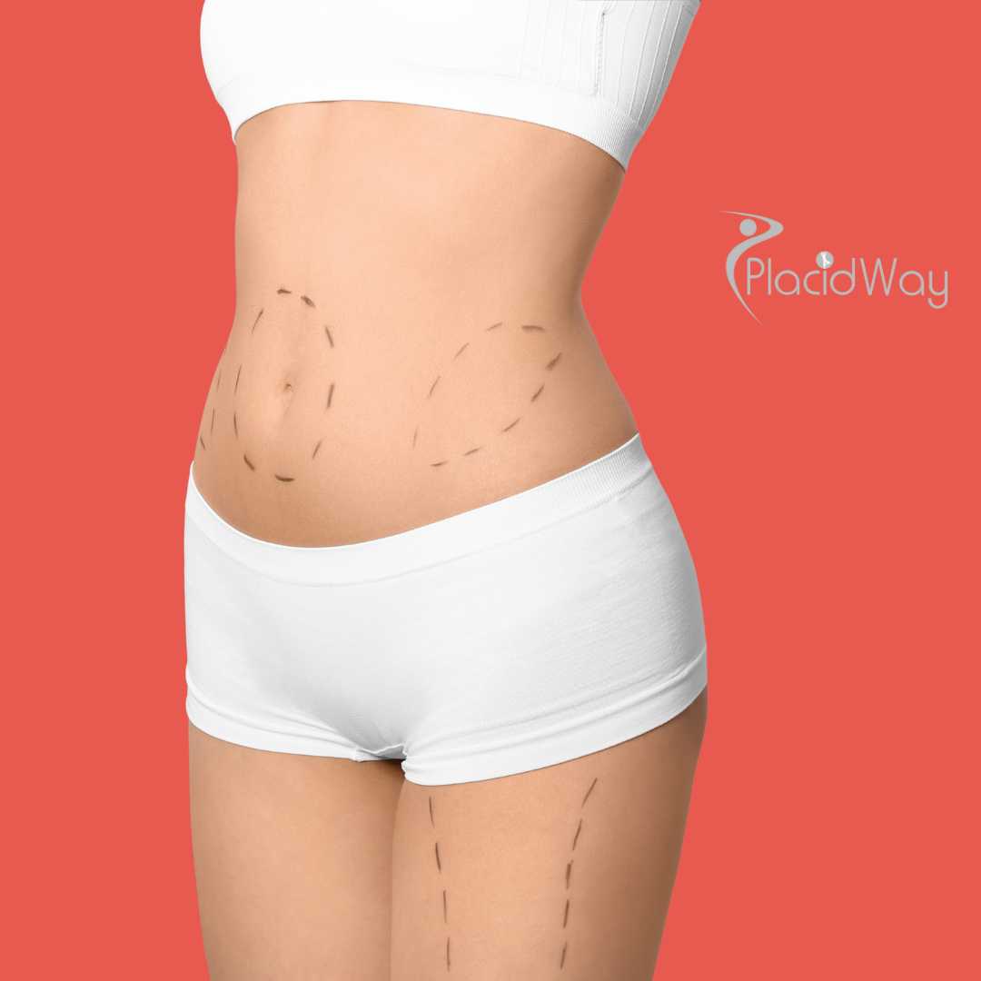 Mommy Makeover in Izmir, Turkey