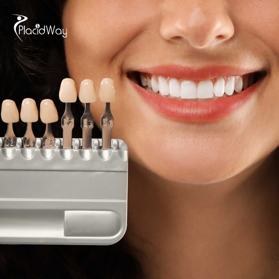 Dental Veneers in Costa Rica