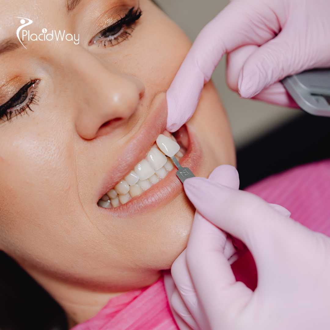 Dental Veneers in Istanbul