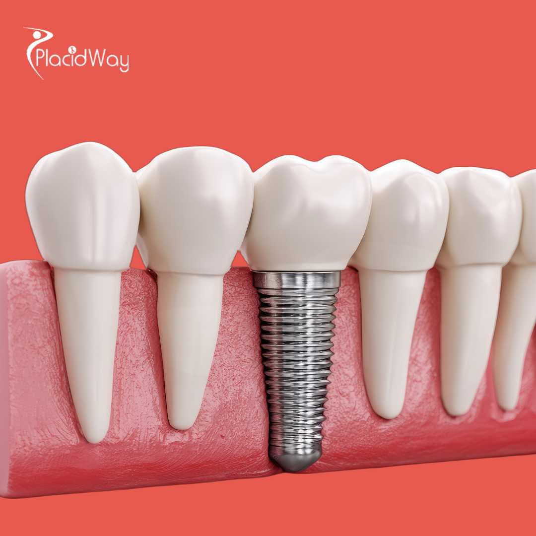 Dental Crowns in Izmir, Turkey