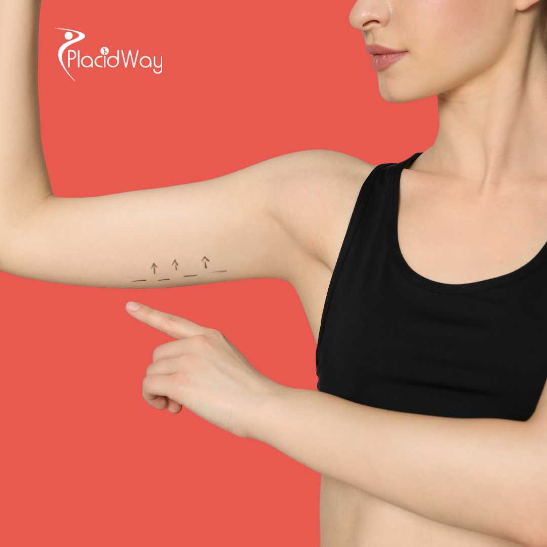 Arm Lift in Seoul, South Korea