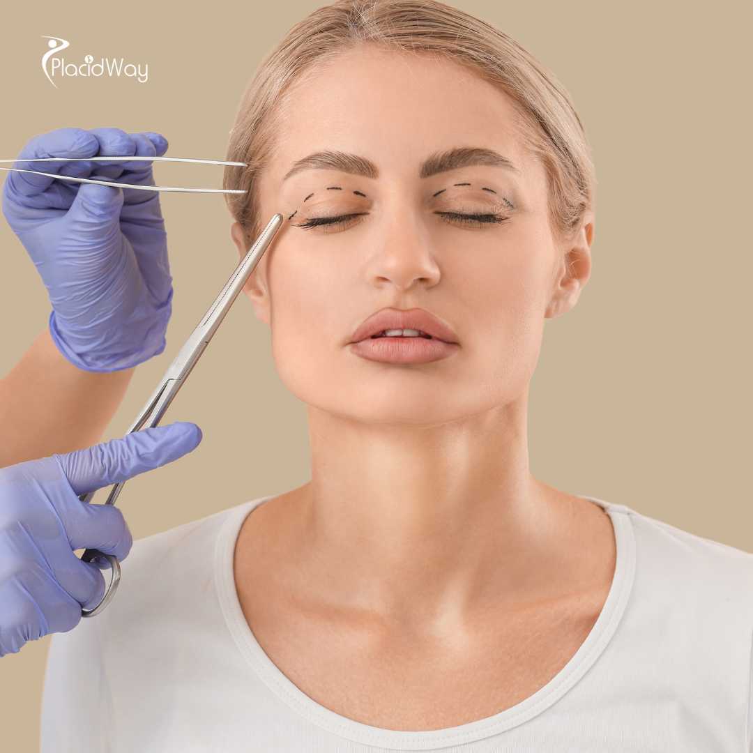 Blepharoplasty in Ensenada, Mexico