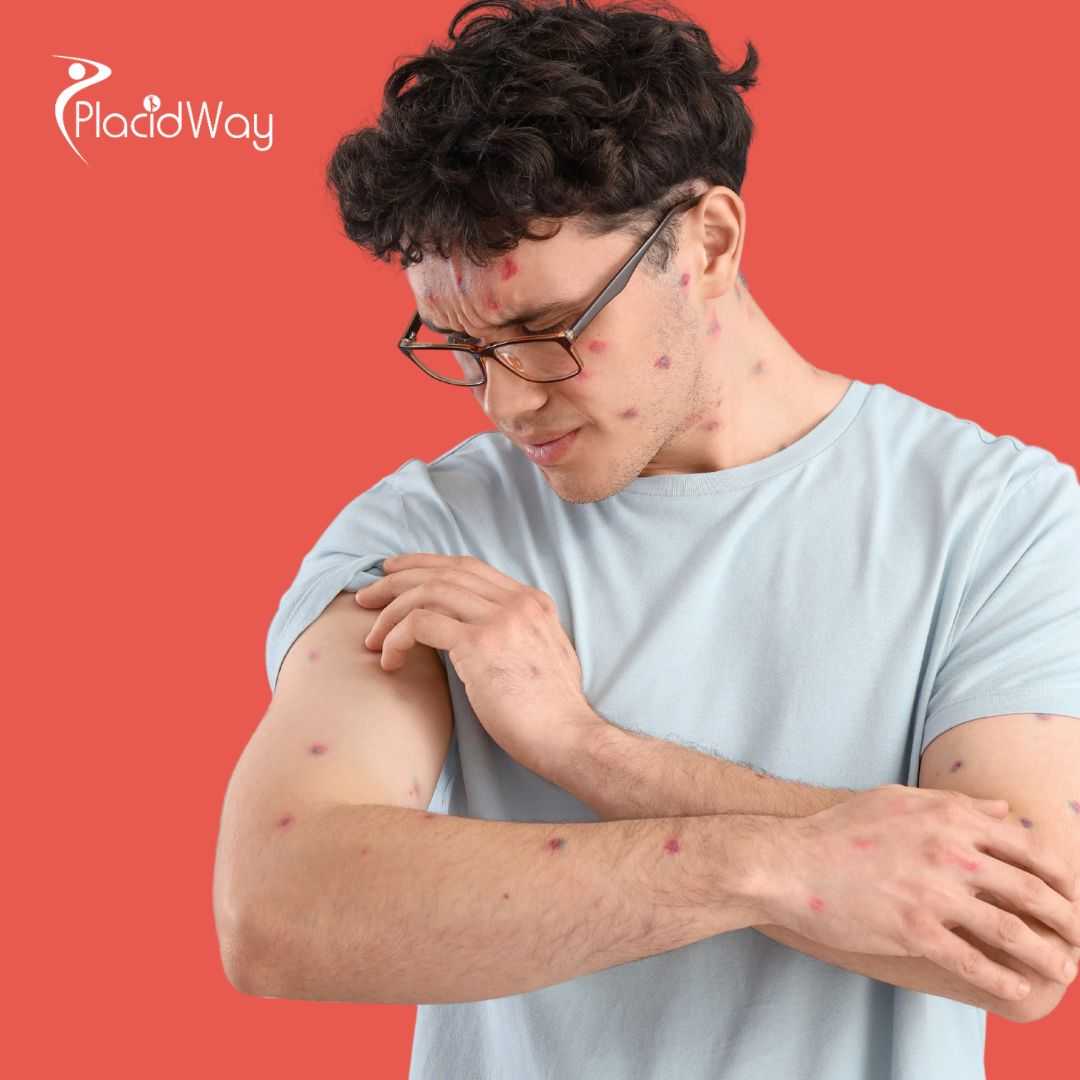 Psoriasis Treatment in Mexico