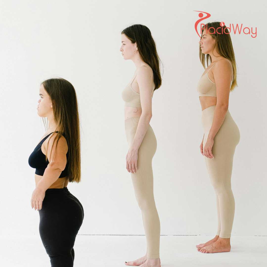 The-Height-Surgery-Viral-Trend-Highlights-Istanbuls-Leg-Lengthening-Dominance
