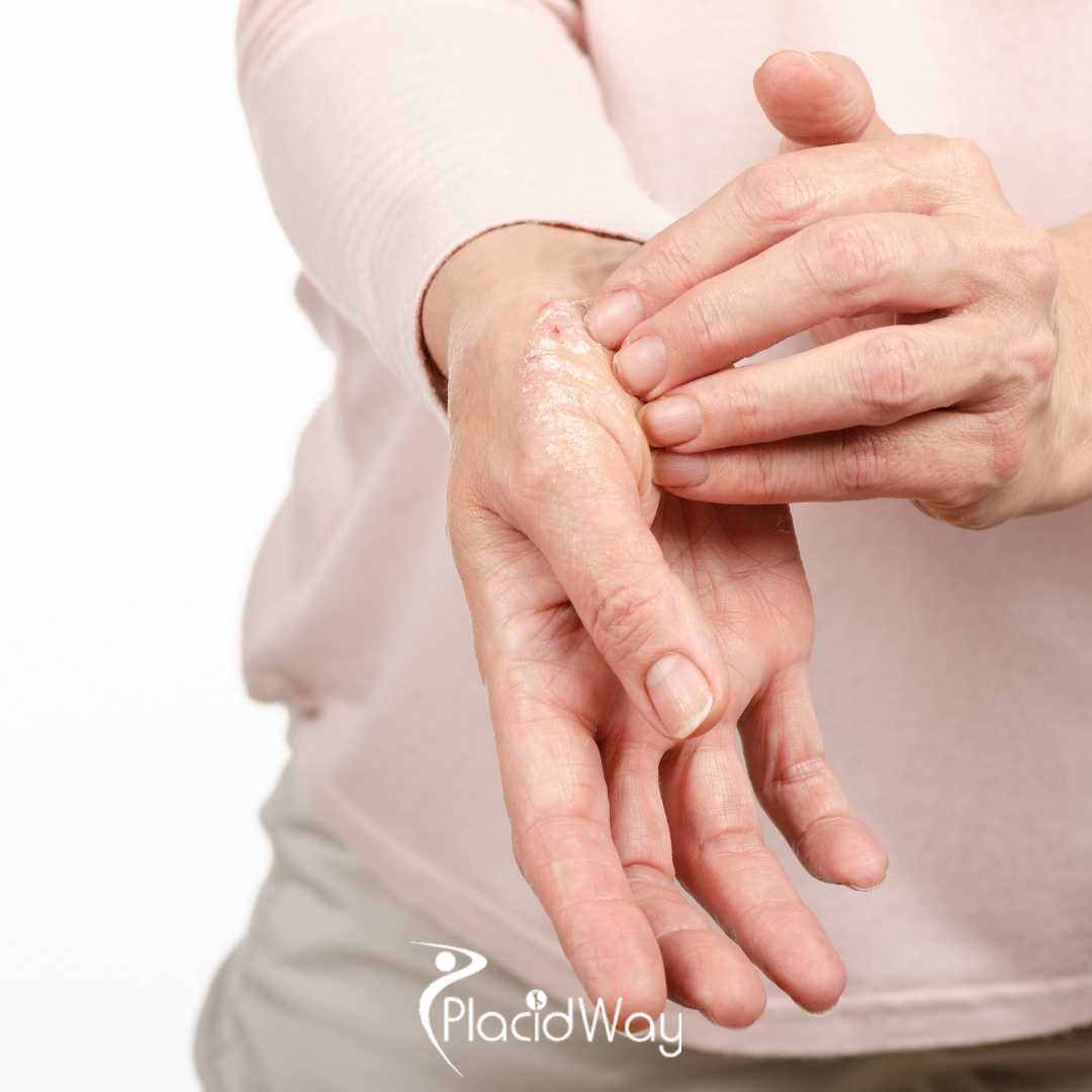 The-End-of-Psoriasis-Plaques-How-Mexicos-Cutting-Edge-Immune-Therapies-Are-Drawing-US-Crowds