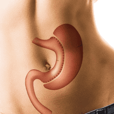 Affordable Gastric Sleeve Surgery Package in Tijuana, Mexico