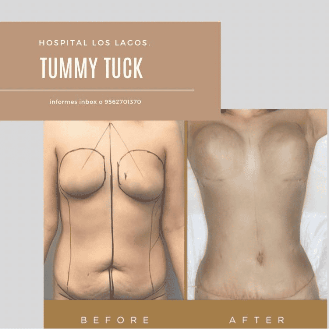El paquete más económico para abdominoplastia en Reynosa, México: $3,700