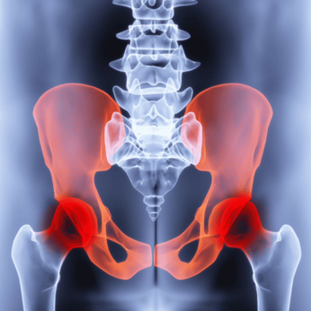 Hip Replacement in Mexico - Explore the Package