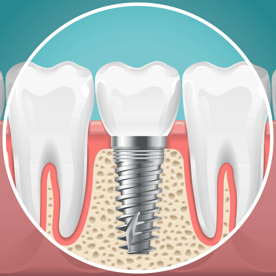 Dental Implants in Colombia - Affordable Tooth Replacement