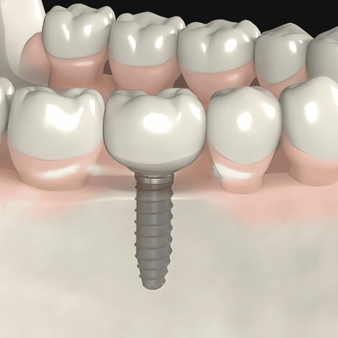 Dental Implants in Los Algodones, Mexico - Package Price $750