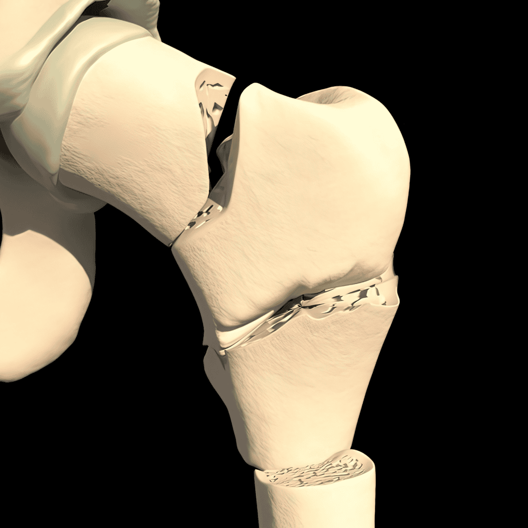 Arthroscopic Joint Surgery in Puerto Vallarta Mexico