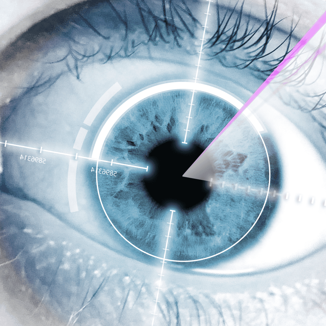 Cataract Femtosecond Laser Surgery in Italy