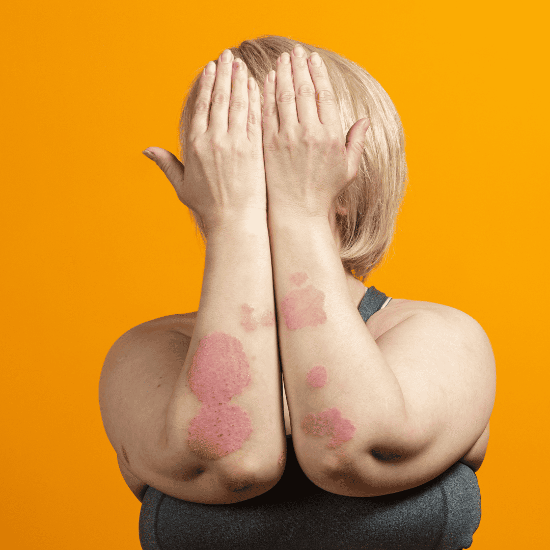 Stem Cell Therapy for Psoriasis Package in Tijuana, Mexico by CellsTime