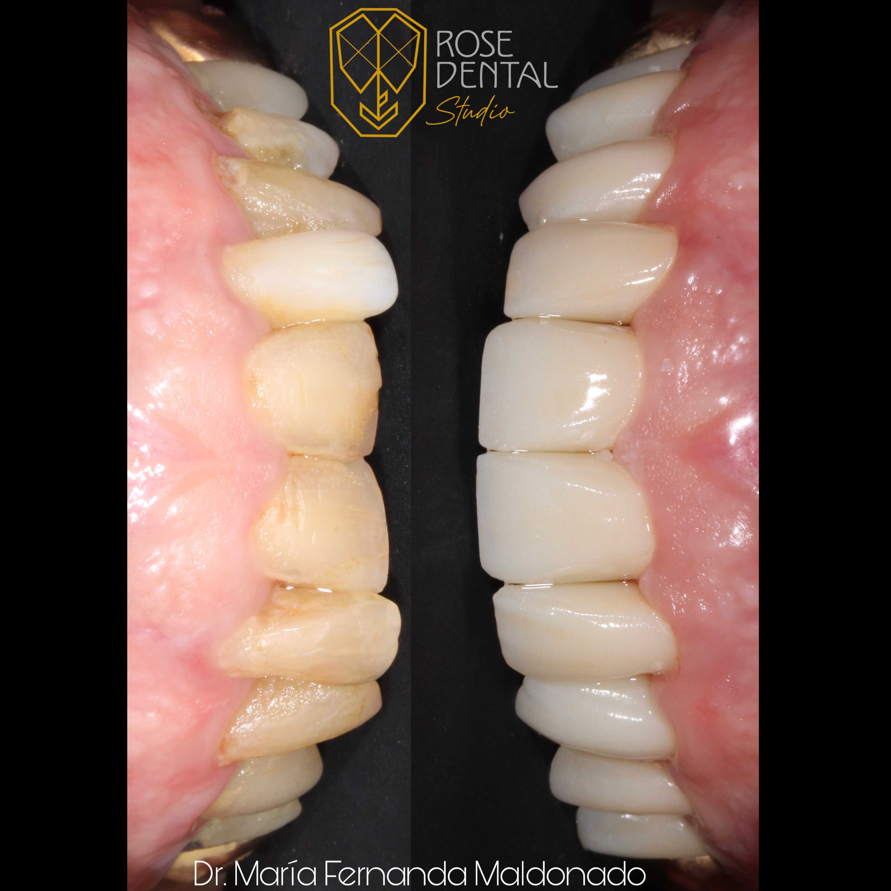 Paquete de coronas dentales de zirconio en Rose Dental Studio, Los Algodones, México