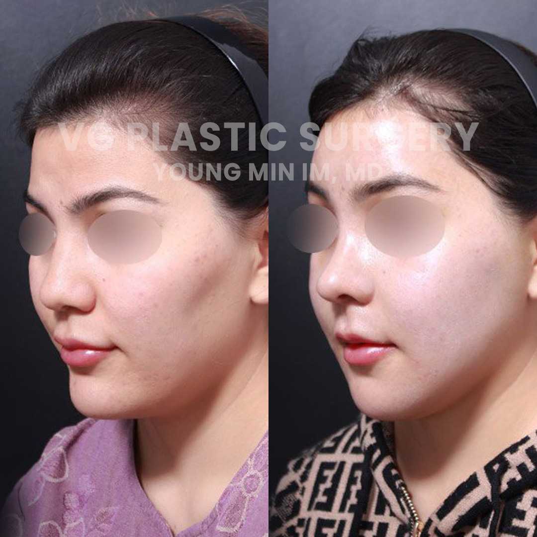 Facial Contouring Package in Seoul, South Korea by VG Plastic Surgery
