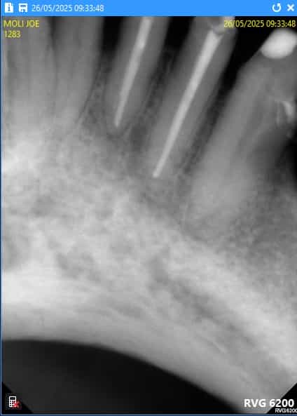 Tratamiento de conductos y reconstrucción en Nuevo Progreso, México