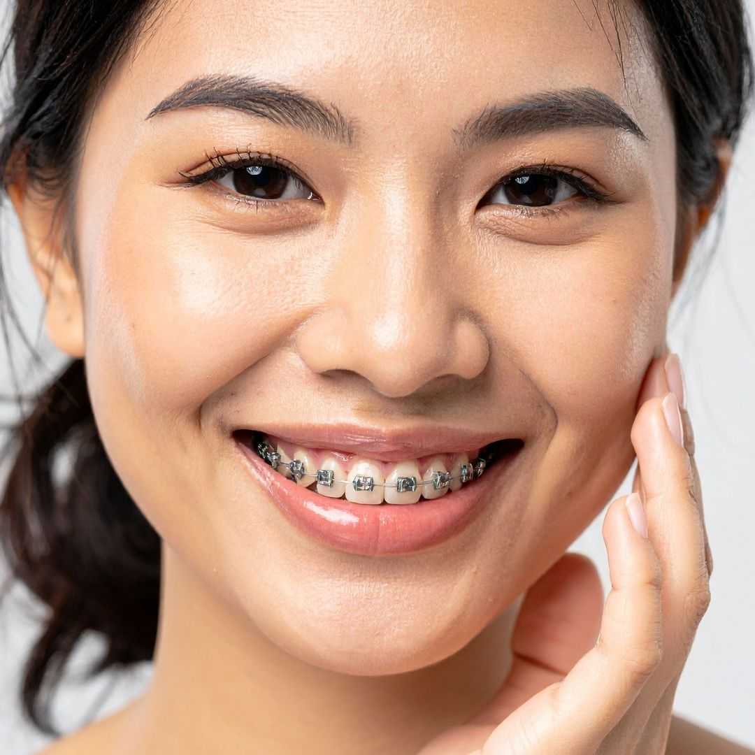 Hollywood Smile Package in Mumbai, India by Smilora Dental Clinic