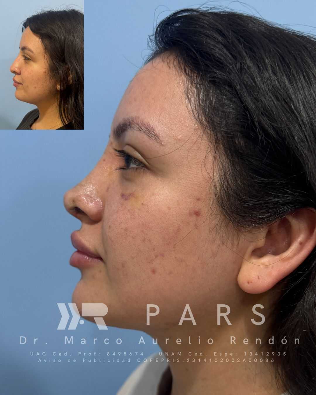 Nose Surgery Rhinoplasty Package at PARS - Plastic, Aesthetic & Reconstructive Surgery in Guadalajara, Mexico, Guadalajara, Mexico