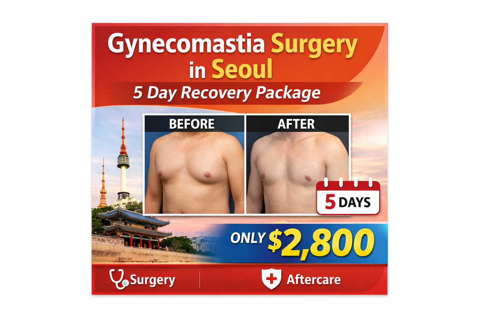 Gynecomastia Surgery in Seoul – 5 Day Recovery Package (Grade 1–2), Seoul, South Korea