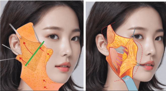 FULLFACE LIFTING PACKAGE (Endoscopic Forehead Lift and Deep Plane Face-neck Lift)